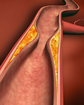 Homocystein_Arterie-mit-Plaque